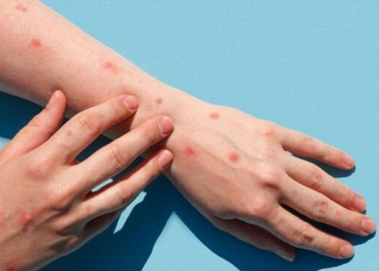 Mpox: Understanding the Disease, Transmission, and Prevention