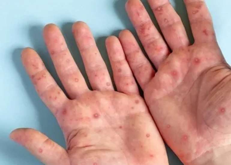 Mpox Virus Outbreak in India: Current Situation and What You Need to Know