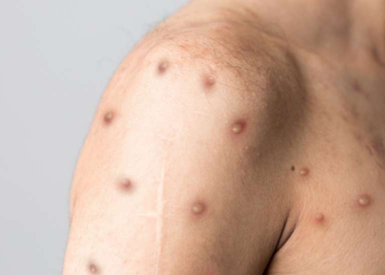 What to Do if You Have Been Exposed to Monkeypox (MPOX)