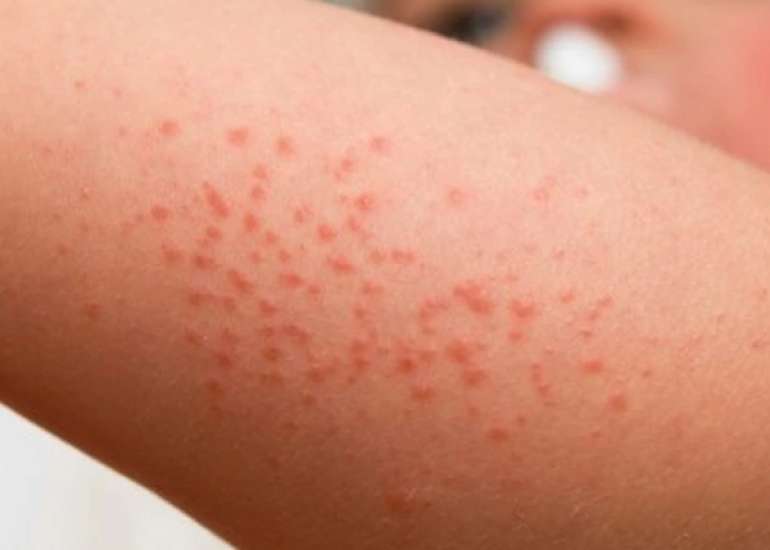 Effectiveness and Safety of Omalizumab and Dupilumab in Treating Chronic Spontaneous Urticaria and Atopic Dermatitis in Pediatric Patients