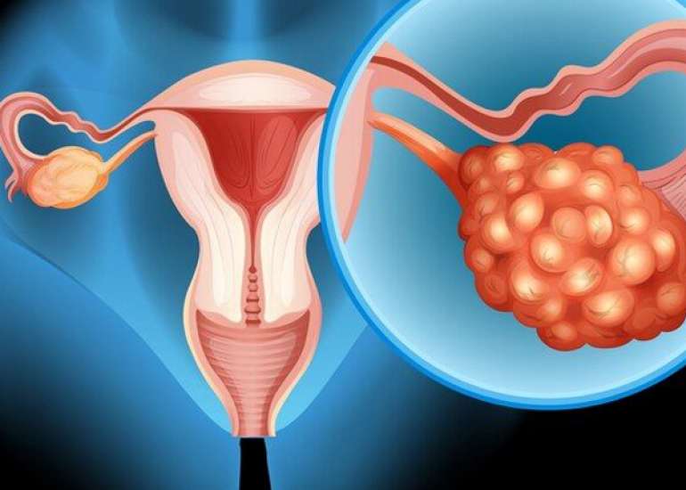 Recognition of Crucial Genes for PCOS and Atherosclerosis via Comprehensive Bioinformatics Analysis and Machine Learning