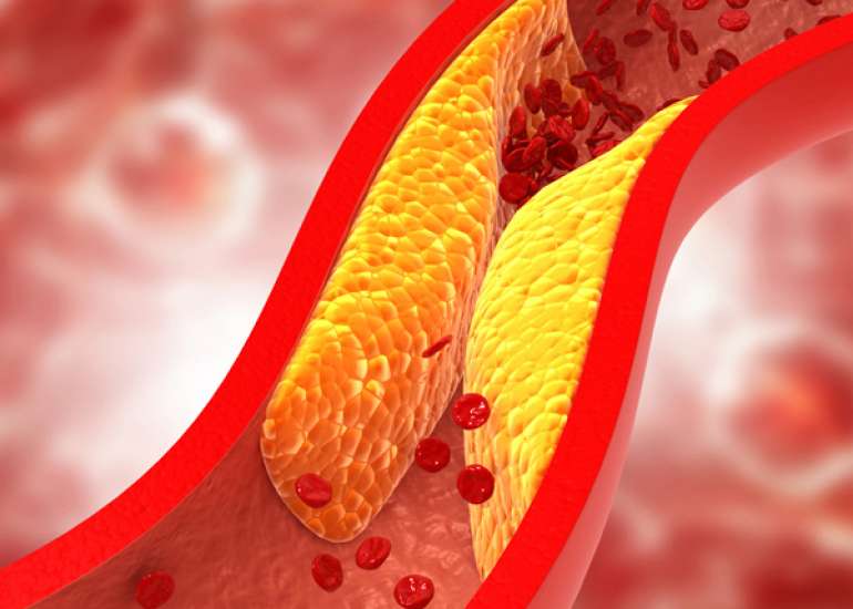 Advances in Dyslipidemia Management: Current Insights and Future Directions