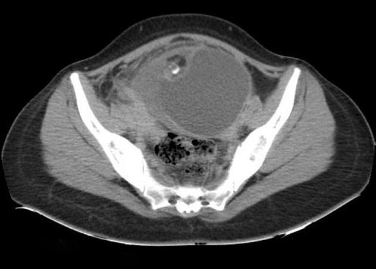 Diagnostic Challenges of a Detached Mature Cystic Teratoma in the Pouch of Douglas