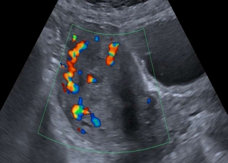Evaluation of Treatment Appropriateness for Secondary Postpartum and Post-Abortion Hemorrhage Due to Uterine Vascular Anomalies