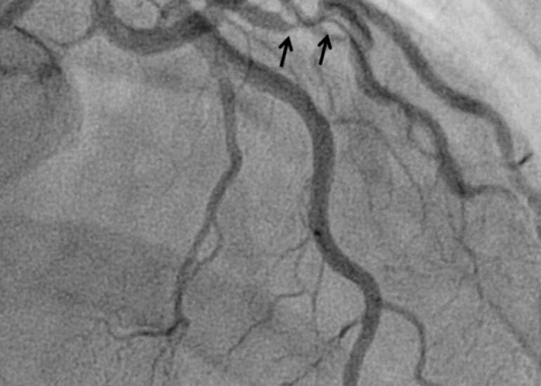 A case study of Isolated Coronary Vasculitis Leading to Myocardial Infarction in an Adolescent