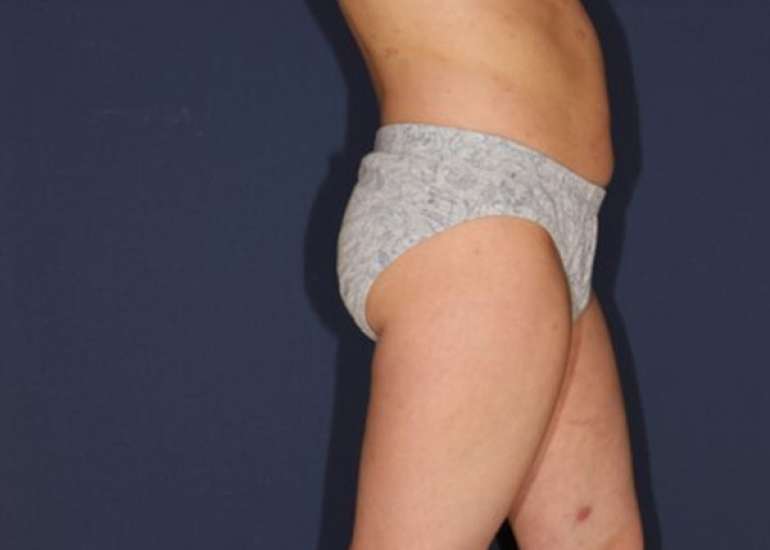 A rare case of Pediatric Mycosis Fungoides presenting as Benign Dermatoses