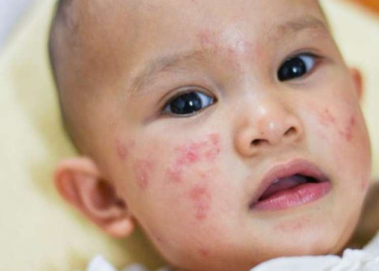 Prevalence and Impact of Skin Disorders in Pediatric Populations