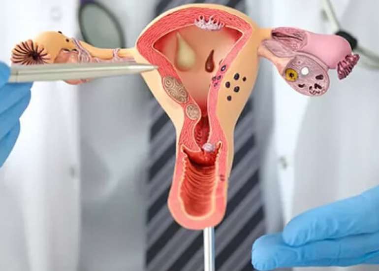 Caloric Restriction Mitigates Hereditary Transmission of PCOS Traits Through Methylation Reprogramming