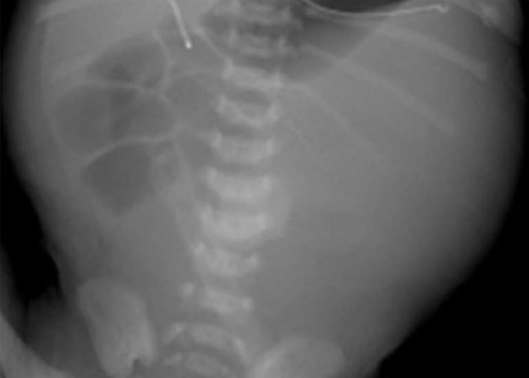 Evaluation of the Modified Martin Procedure for Megacystis Microcolon Intestinal Hypoperistalsis Syndrome
