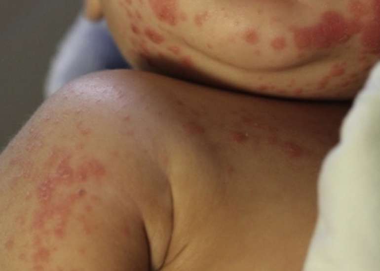 Clinical Outcomes of Cyclosporine Treatment in Kawasaki Disease