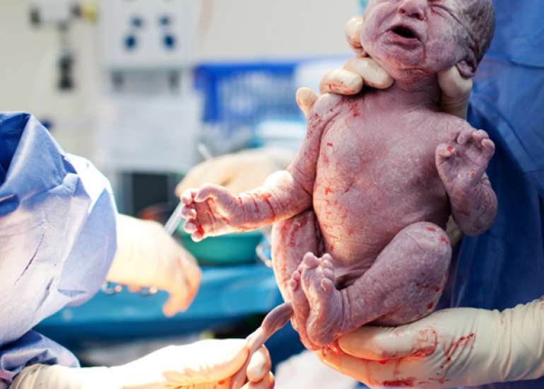 Comparison of Maternal and Neonatal Outcomes in Labor Induction: 25 µg vs. 50 µg Oral Misoprostol