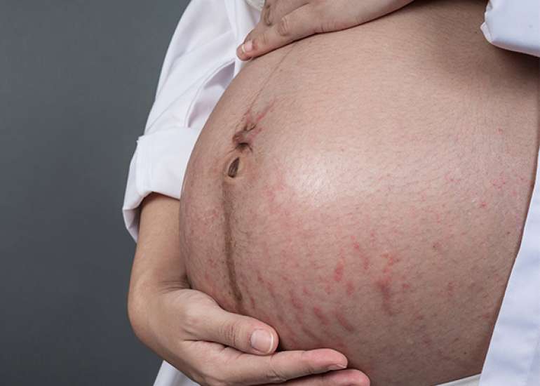 Effects of Oral Arginine and IV Hydration on Amniotic Fluid Index in Oligohydramnios