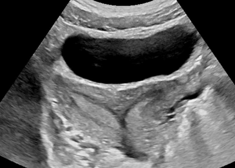 A case study of Herlyn Werner Wunderlich Syndrome (OHVIRA) 