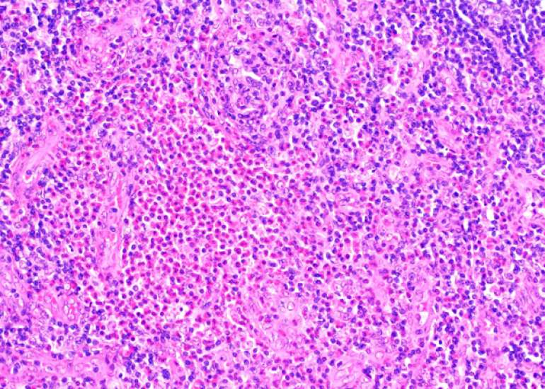 A case study of Kimura’s Disease in a 14-Year-Old Boy with Nephrotic Syndrome