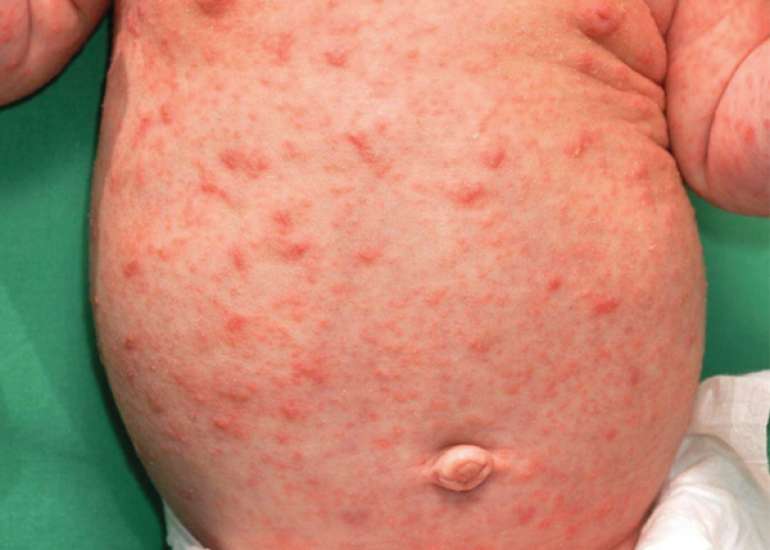 A review of Scabies in infants and children