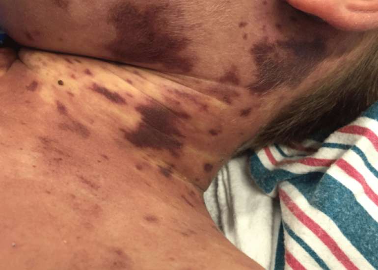 A Case of Meningococcal Pericarditis: Uncommon Complication of Purpura Fulminans