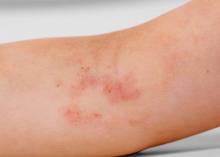 Summary of Research on Emollient Treatment and Atopic Dermatitis Prevention in Children