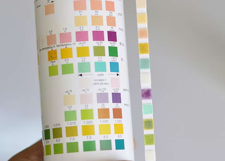 Analysis of Urine Dipstick Analysis for Screening Urinary Abnormalities in Asymptomatic Children