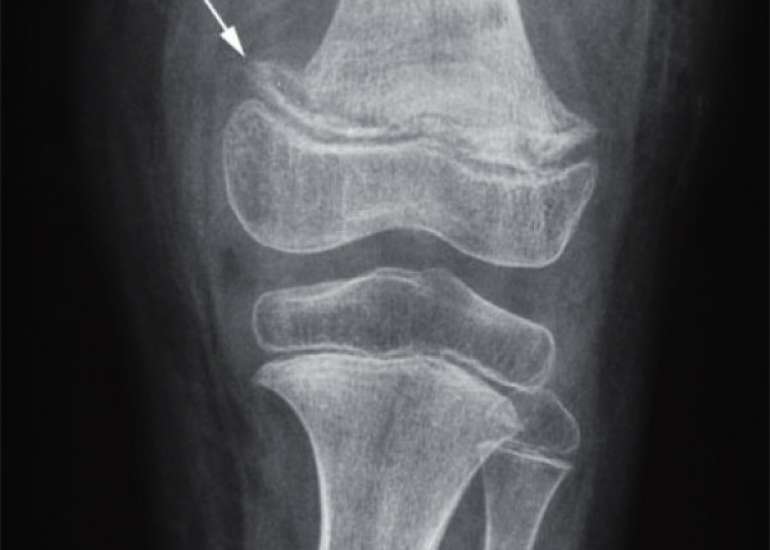 A Case Report of diagnosing Scurvy in a 4-Year-Old Boy with Progressive Limb Pain