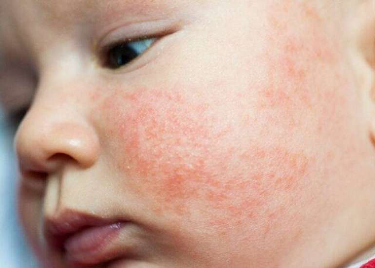 Summary of Review on Treatments for Moderate to Severe Atopic Dermatitis in Pediatric Patients