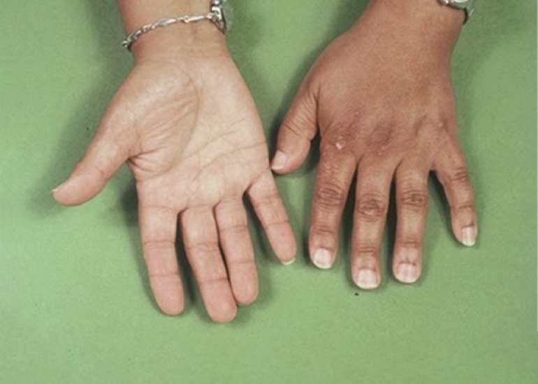 Characteristics and Pregnancy Outcomes in Women with Primary Adrenal Insufficiency