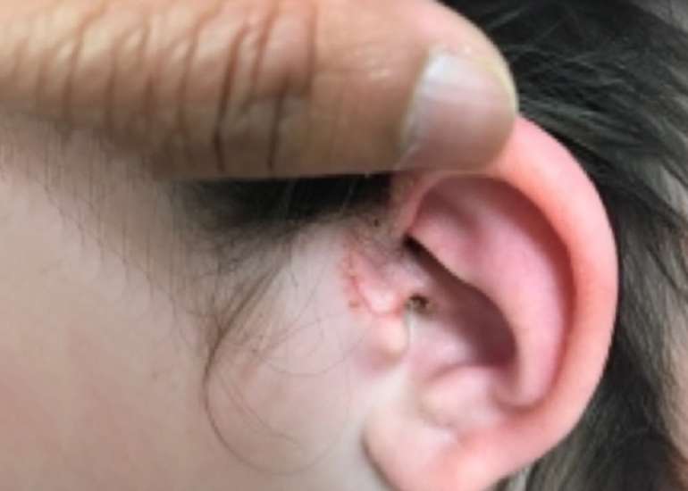 Cardiac Myxoid Spindle Cell Tumor in a Neonate