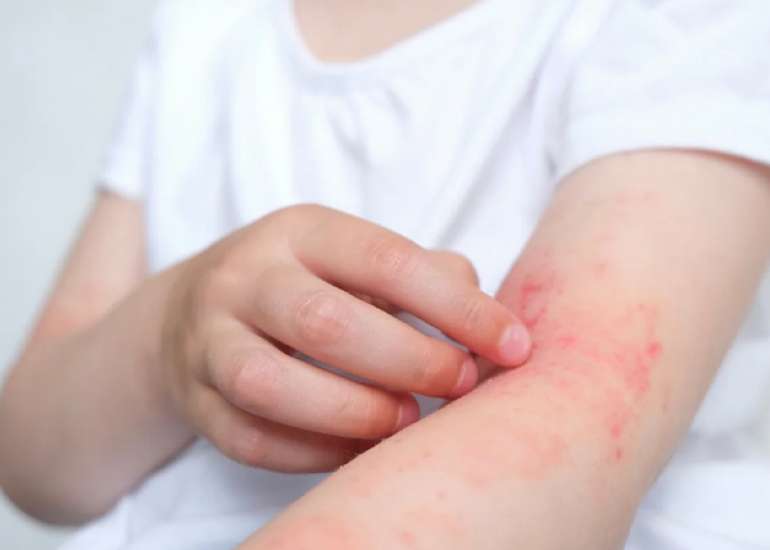 Skin Microbiome of Atopic Dermatitis