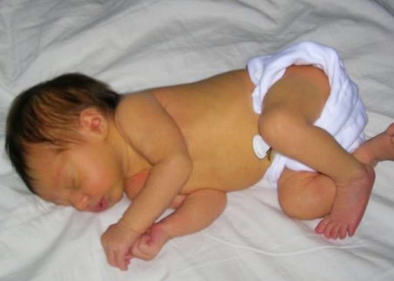 Hyponatremia in Children