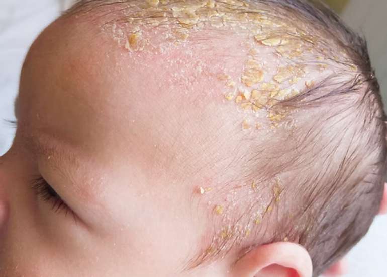 Interventions for Infantile Seborrheic Dermatitis 