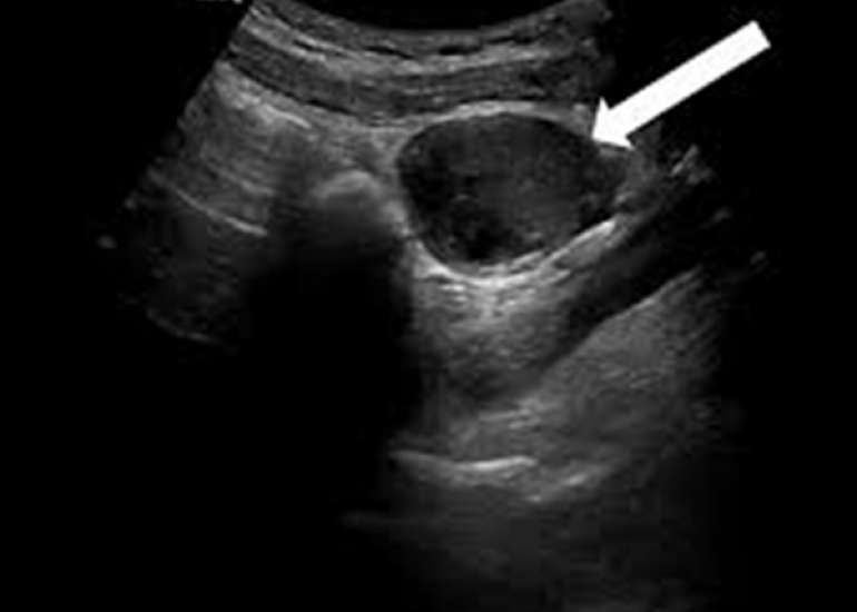 Isolated Fallopian Tube Torsion in Term Pregnancy