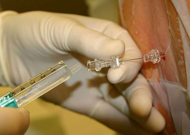 Intrathecal Bupivacaine with Buprenorphine Confers Prolonged Analgesia During C-Sections