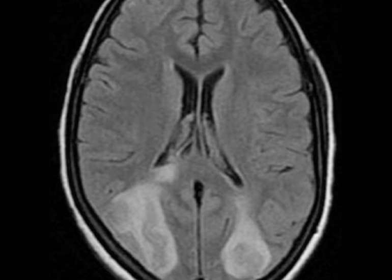 Neuroimaging Features in Eclamptic Encephalopathy 
