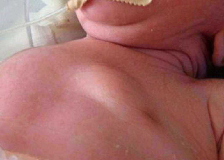 Axillary Web Syndrome in a Child Without Prior Surgery: A Rare Case