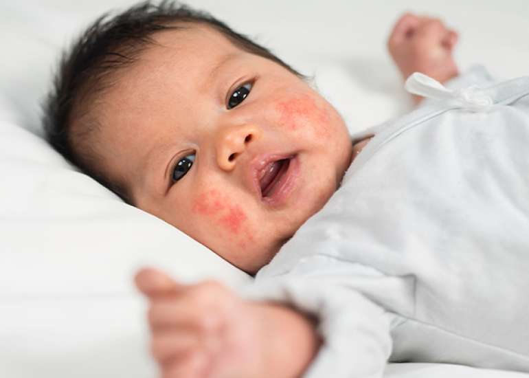 Pediatric Atopic Dermatitis and Biologics: Suitability in the Under-6 Age Group