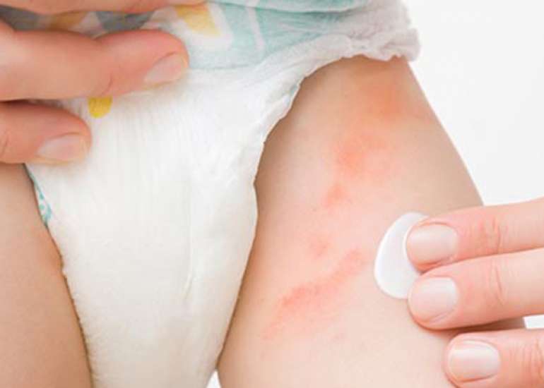 Diaper Dermatitis in Early Life: Global Challenges and Management Trends