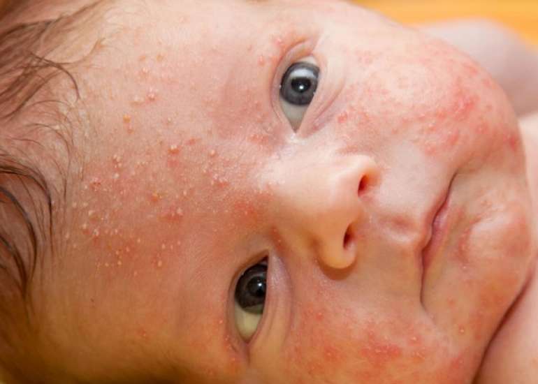  Pediatric Eczema: Diagnosis and Treatment Insights