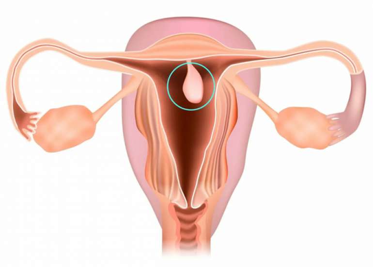 Endometrial Polyps and Postoperative Septic Shock in a Young Woman