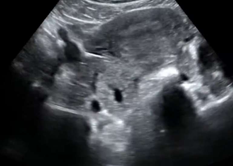 A Rare Case of Ectopic Molar Pregnancy
