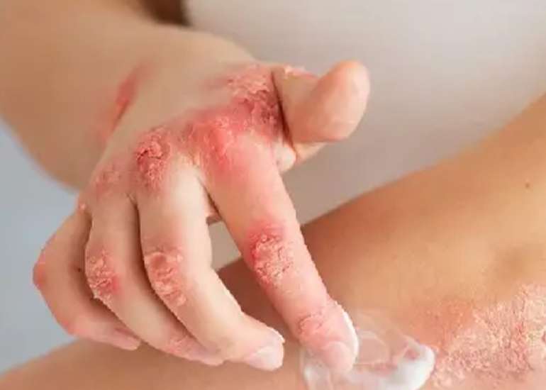 Emollient Use in Preventing Atopic Dermatitis – What Does the Evidence Say?