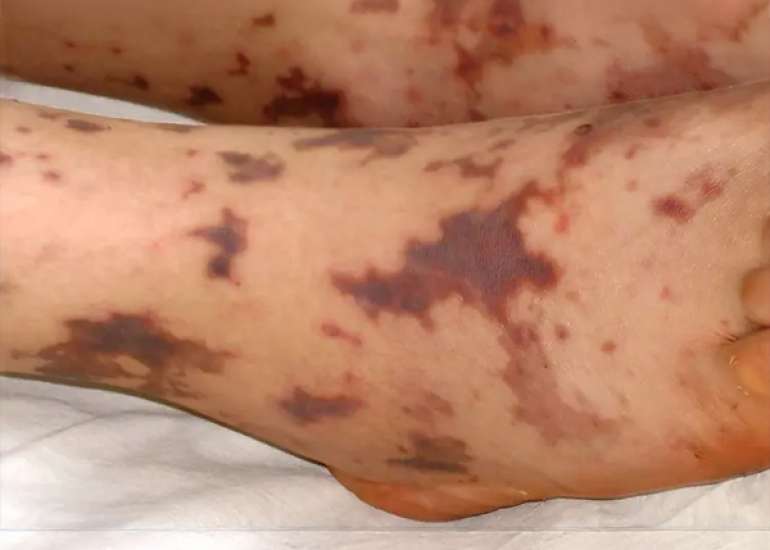 Meningococcemia Presenting with Purpura Fulminans and Pericardial Involvement