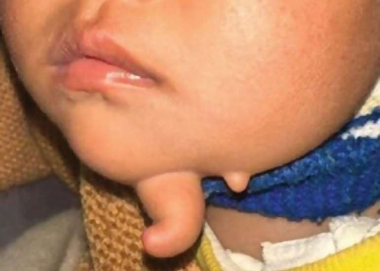 A Rare Case of Faciomandibular Teratoma with Unique Finger-Like Appearance