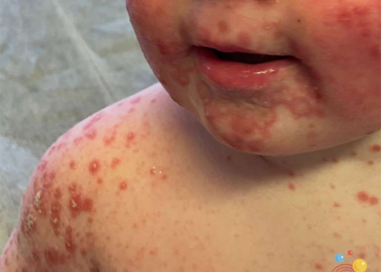 Atopic Dermatitis in Childhood and Pubertal Development: A Nationwide Cohort Study