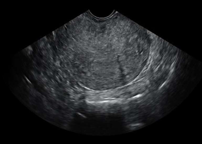 Postmenopausal Ovarian Torsion Mimicking an Abdominopelvic Mass: A Case Report