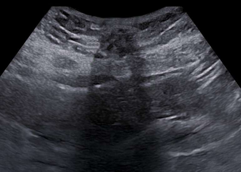 Diagnosis and Surgical Management of Inguinal Endometriosis