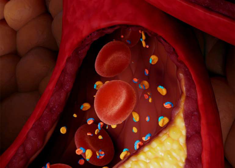 Familial Chylomicronemia Syndrome Presenting as Encephalopathy in an Infant