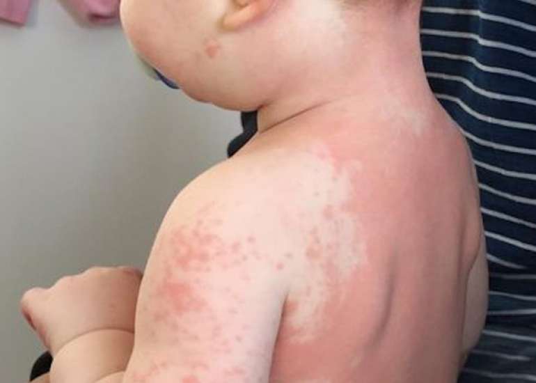 Rising Incidence and Urgent Management Needs of Kawasaki Disease in Children