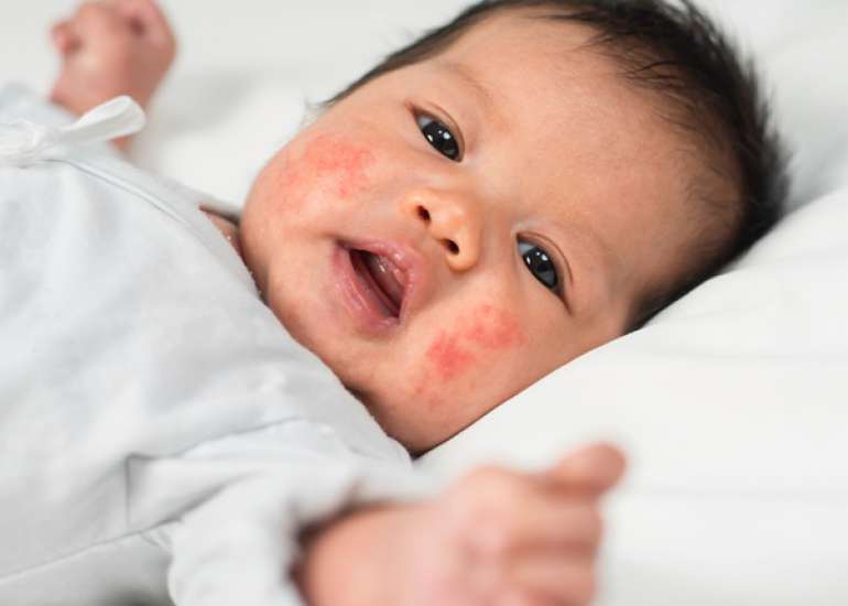Advances in Pediatric Atopic Dermatitis Management