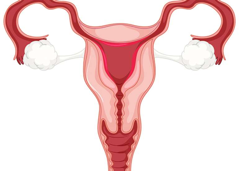 Accessory Cavitated Uterine Mass: A case of variant Mullerian Anomaly