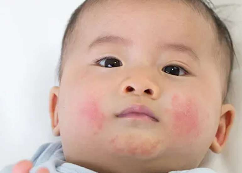 Updated AAP Guidance on Managing Atopic Dermatitis in Children