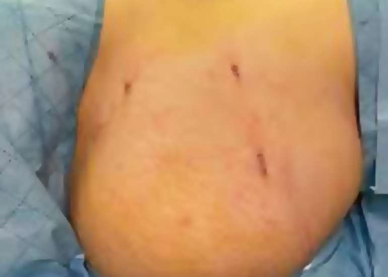 A Case of Abdominal Wound Breakdown Following Appendectomy in Late Pregnancy